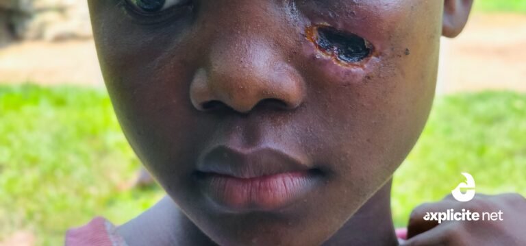 Alerte-SOS Baliverne : la maladie du charbon menace à Dame-Marie